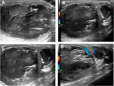 Primary Borderline Mucinous Testicular Tumor: A Case Report and Literature Review